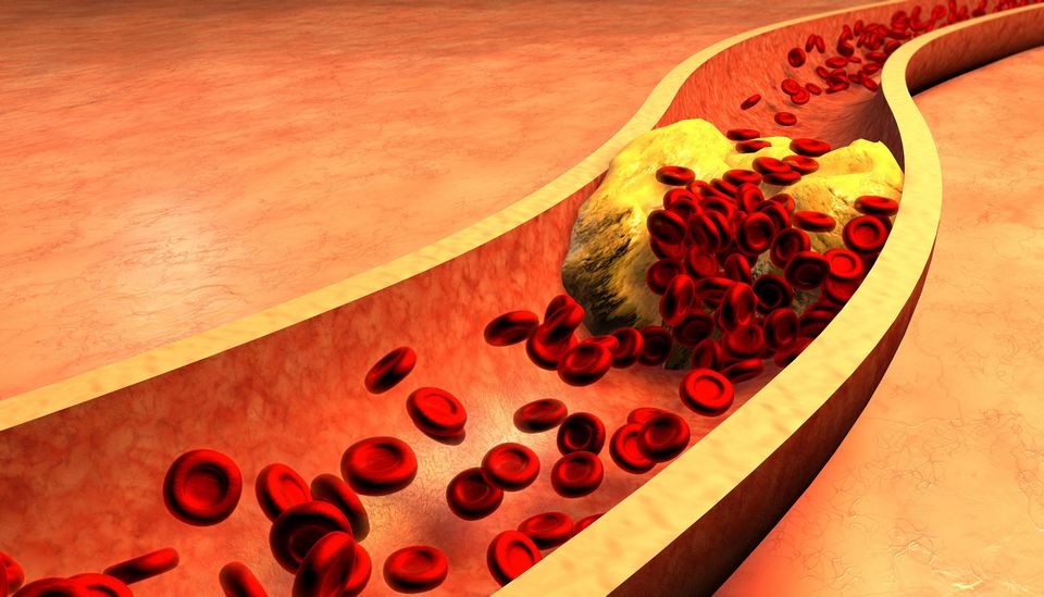 چربی خون چیست و چه علائمی در بدن دارد ؟